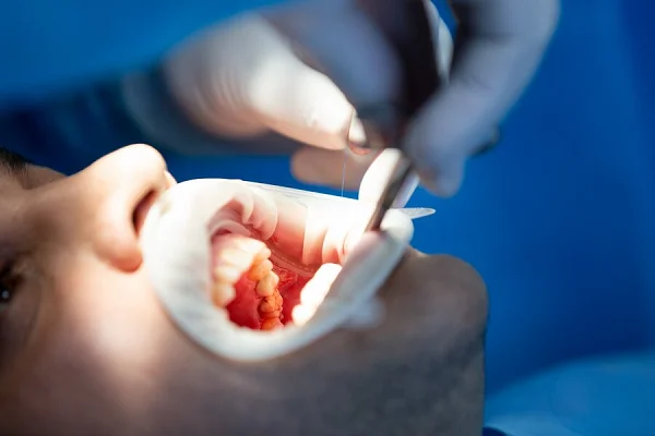 EXTRACTIONS